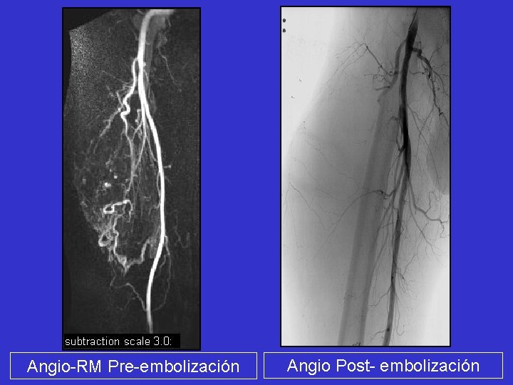 Angio-RM Pre-embolización Angio Post- embolización 