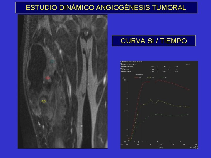 ESTUDIO DINÁMICO ANGIOGÉNESIS TUMORAL CURVA SI / TIEMPO 