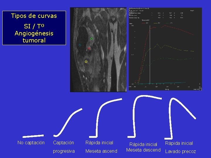 Tipos de curvas SI / Tº Angiogénesis tumoral No captación Captación Rápida inicial progresiva