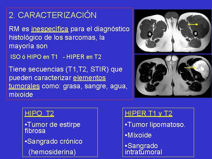 2. CARACTERIZACIÓN RM es inespecífica para el diagnóstico histológico de los sarcomas, la mayoría
