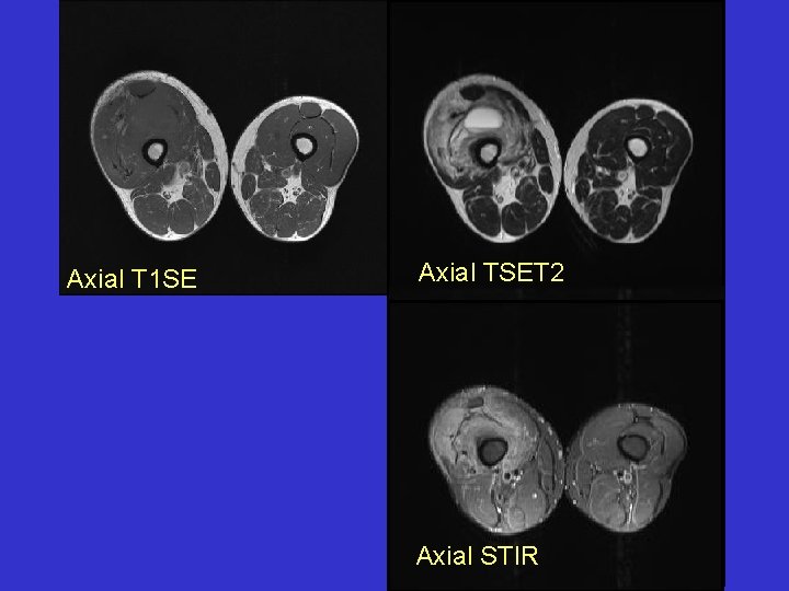 Axial T 1 SE Axial TSET 2 Axial STIR 