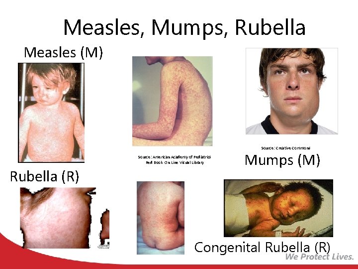 Measles, Mumps, Rubella Measles (M) Source: Creative Commons Source: American Academy of Pediatrics Red