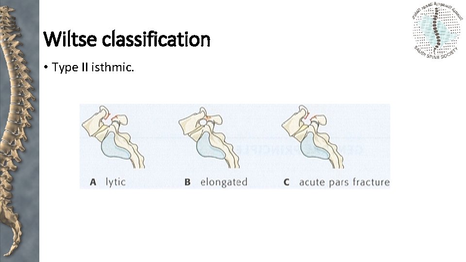 Wiltse classification • Type II isthmic. 