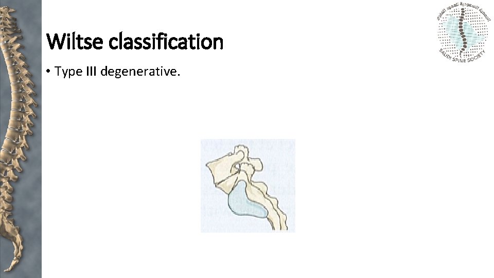 Wiltse classification • Type III degenerative. 