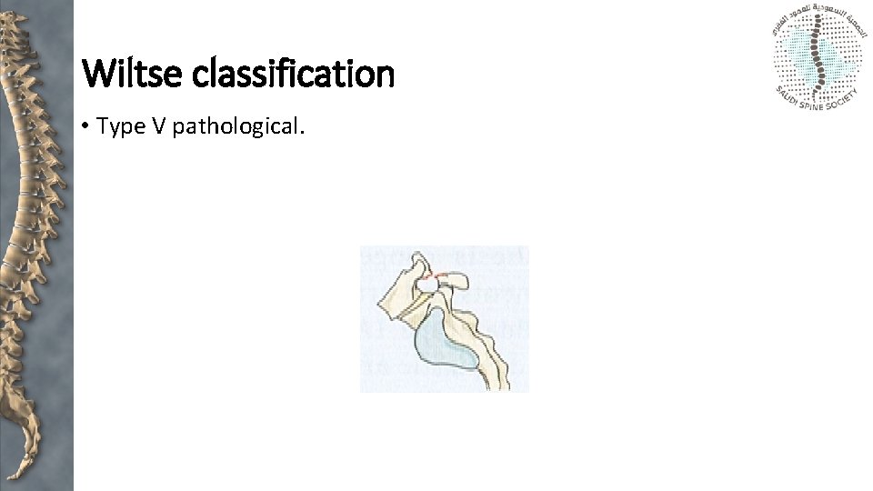 Wiltse classification • Type V pathological. 