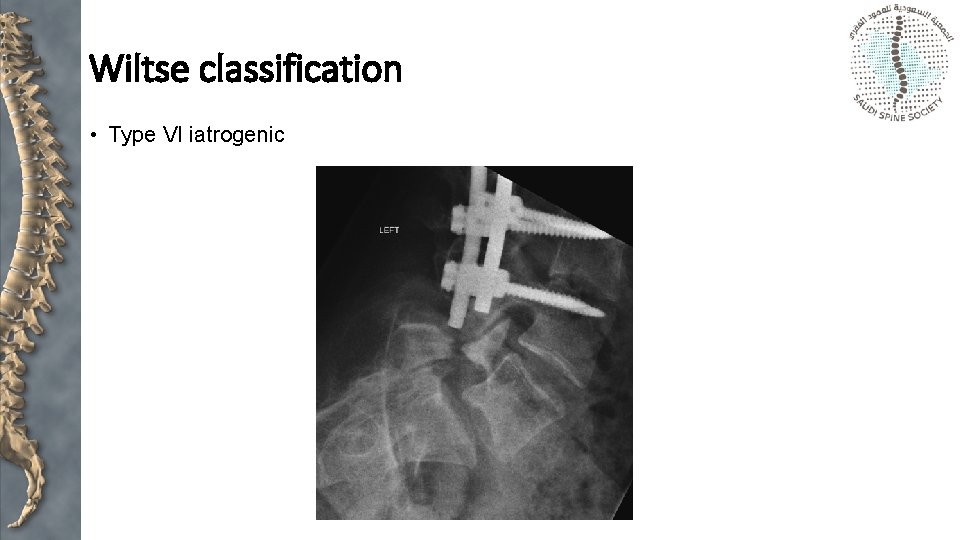 Wiltse classification • Type VI iatrogenic 