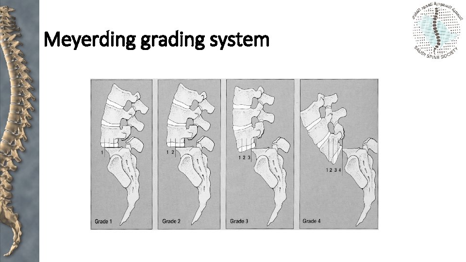 Meyerding grading system 