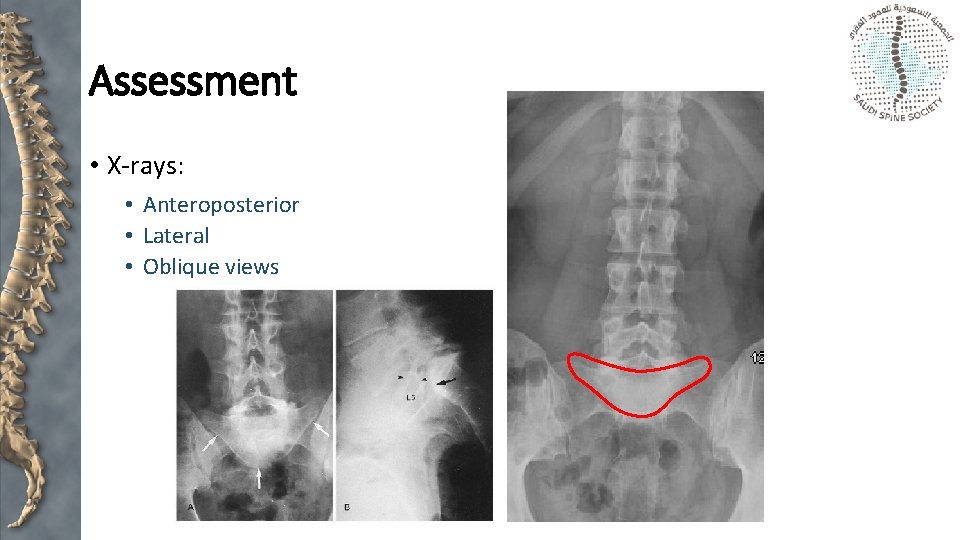 Assessment • X-rays: • Anteroposterior • Lateral • Oblique views 
