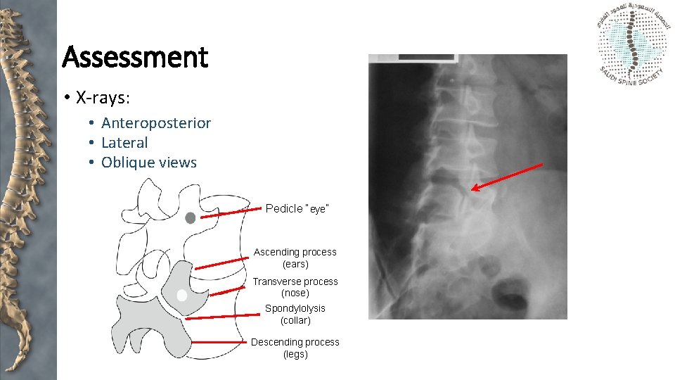 Assessment • X-rays: • Anteroposterior • Lateral • Oblique views Pedicle “eye” Ascending process