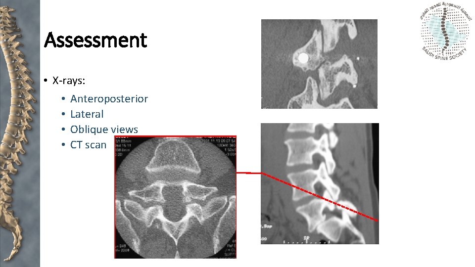 Assessment • X-rays: • • Anteroposterior Lateral Oblique views CT scan 
