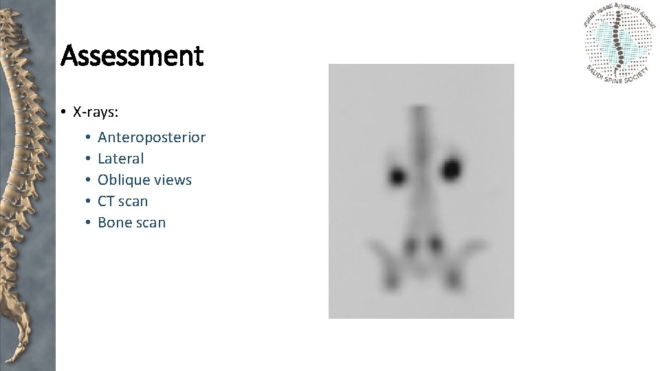 Assessment • X-rays: • • • Anteroposterior Lateral Oblique views CT scan Bone scan