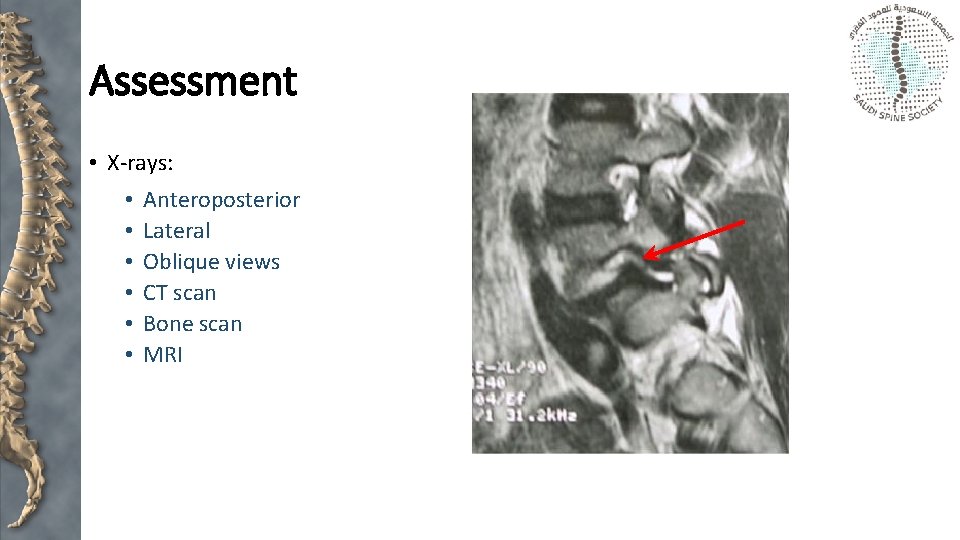 Assessment • X-rays: • • • Anteroposterior Lateral Oblique views CT scan Bone scan