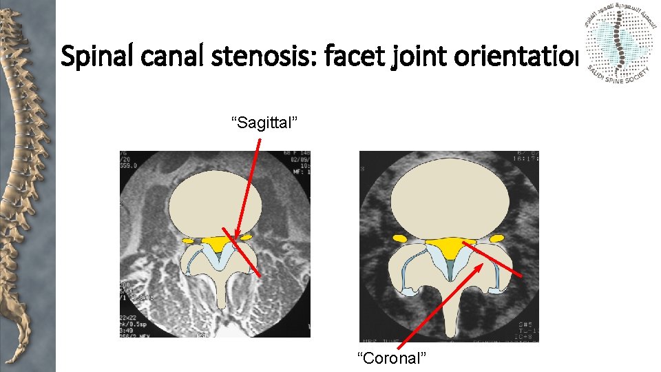 Spinal canal stenosis: facet joint orientation “Sagittal” “Coronal” 