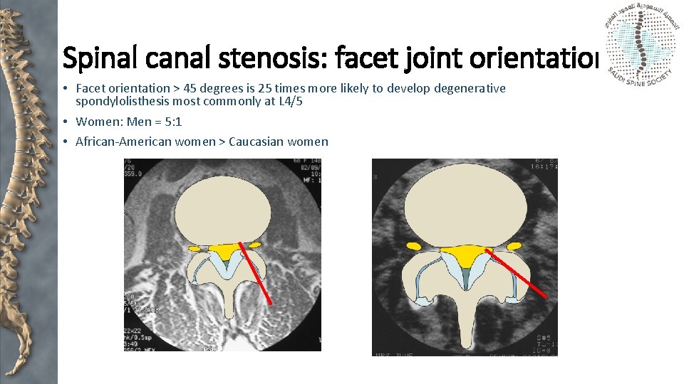 Spinal canal stenosis: facet joint orientation • Facet orientation > 45 degrees is 25