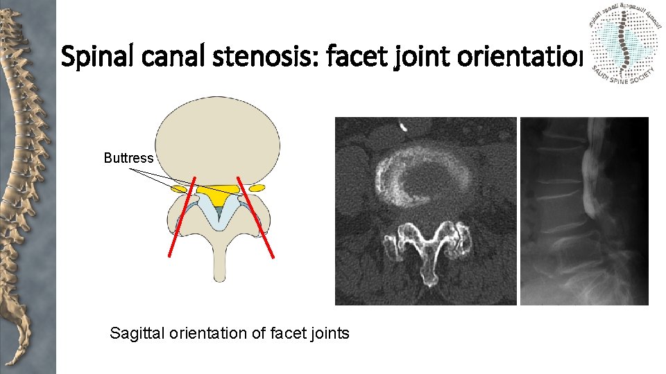 Spinal canal stenosis: facet joint orientation Buttress Sagittal orientation of facet joints 