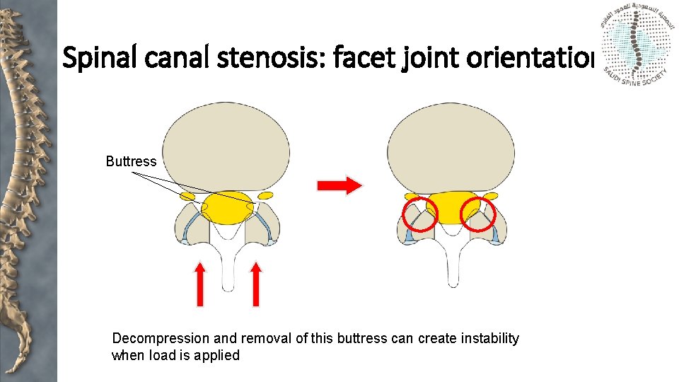 Spinal canal stenosis: facet joint orientation Buttress Decompression and removal of this buttress can