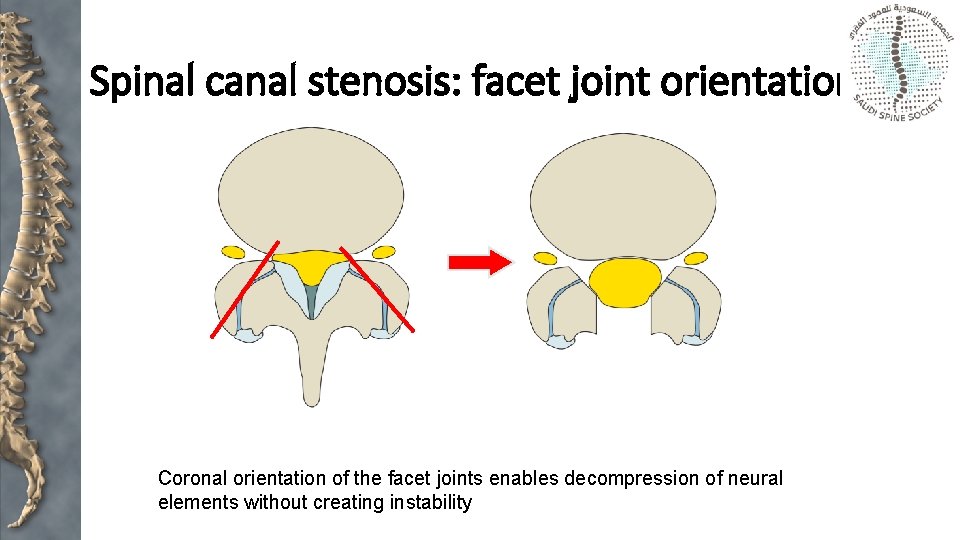 Spinal canal stenosis: facet joint orientation Coronal orientation of the facet joints enables decompression