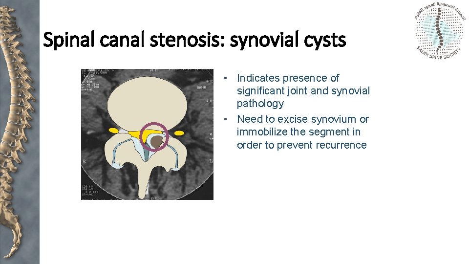 Spinal canal stenosis: synovial cysts • Indicates presence of significant joint and synovial pathology
