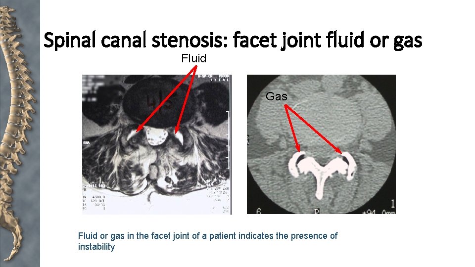 Spinal canal stenosis: facet joint fluid or gas Fluid Gas Fluid or gas in