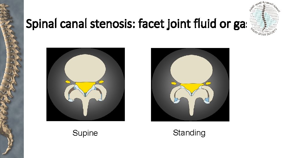 Spinal canal stenosis: facet joint fluid or gas Supine Standing 