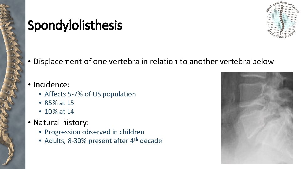 Spondylolisthesis • Displacement of one vertebra in relation to another vertebra below • Incidence: