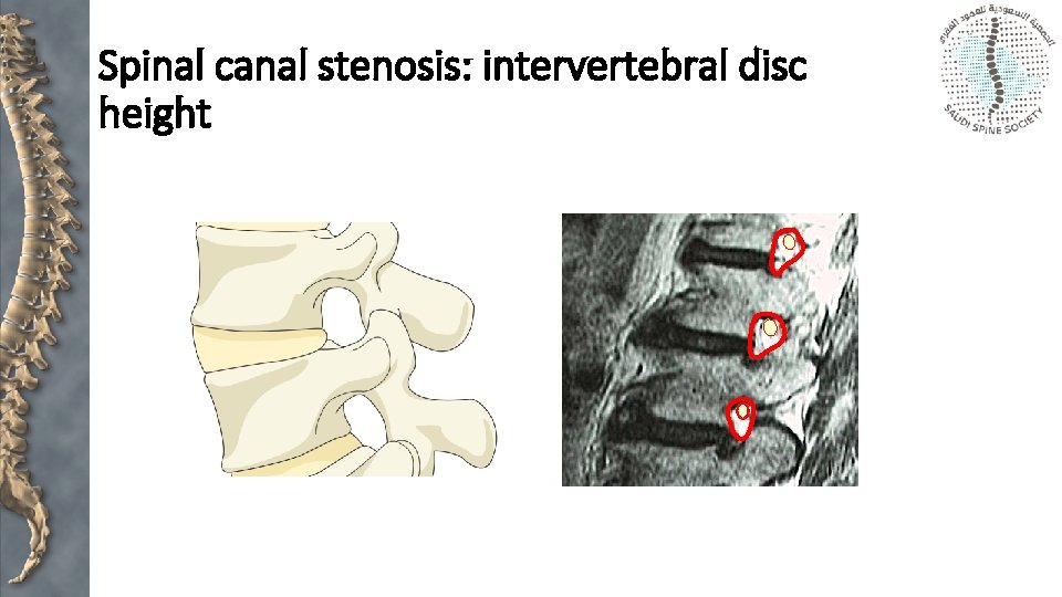 Spinal canal stenosis: intervertebral disc height 