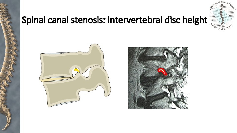 Spinal canal stenosis: intervertebral disc height 