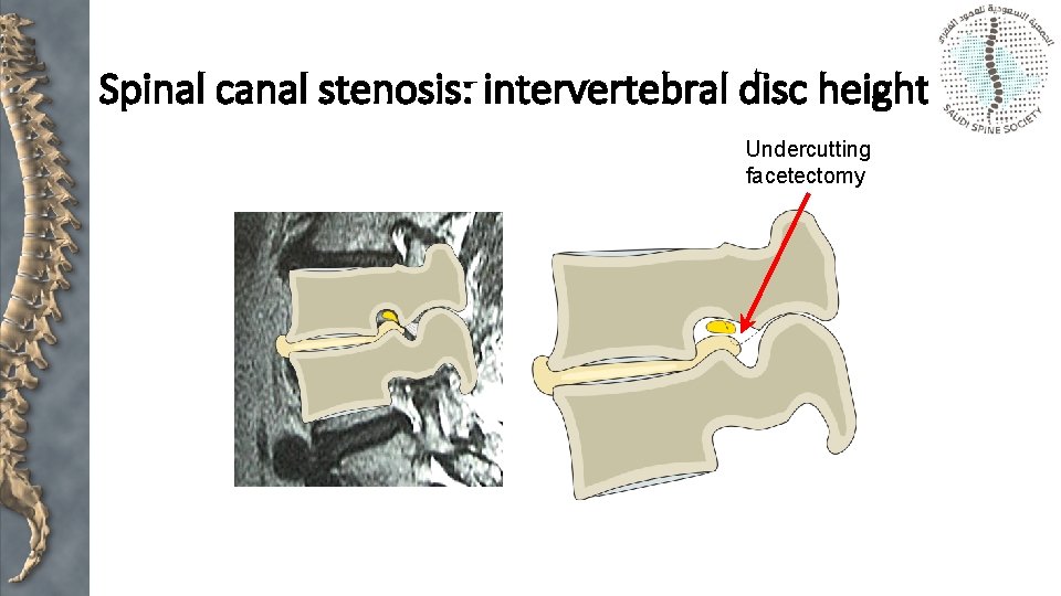 Spinal canal stenosis: intervertebral disc height Undercutting facetectomy 