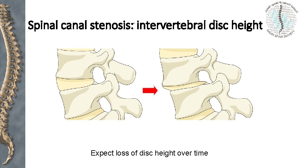 Spinal canal stenosis: intervertebral disc height Expect loss of disc height over time 