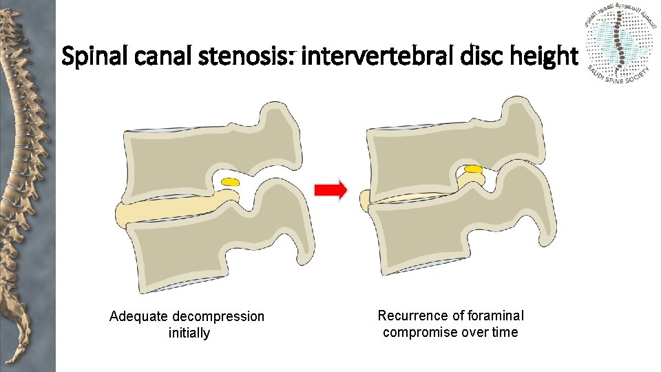 Spinal canal stenosis: intervertebral disc height Adequate decompression initially Recurrence of foraminal compromise over