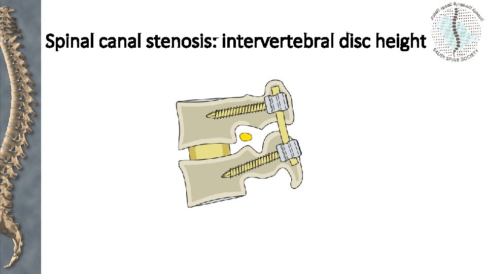 Spinal canal stenosis: intervertebral disc height 