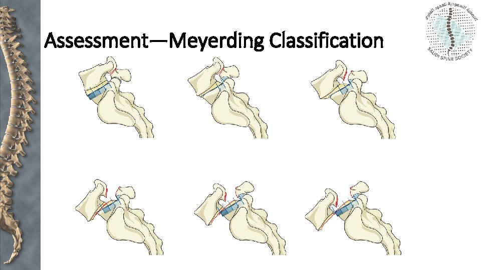 Assessment—Meyerding Classification 