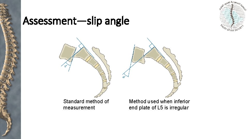 Assessment—slip angle Standard method of measurement Method used when inferior end plate of L