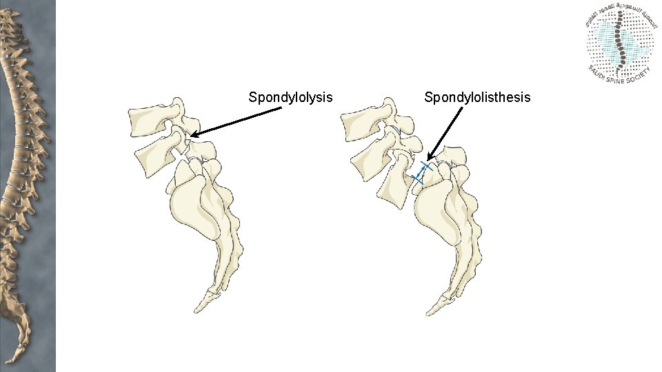 Spondylolysis Spondylolisthesis 