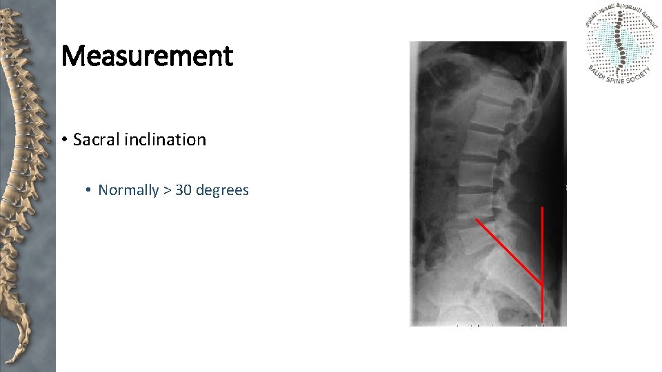 Measurement • Sacral inclination • Normally > 30 degrees 