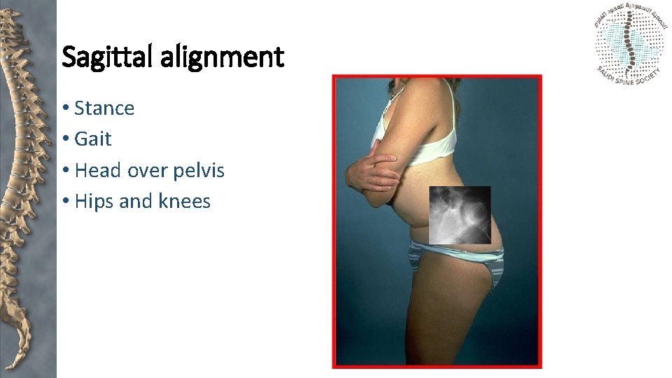 Sagittal alignment • Stance • Gait • Head over pelvis • Hips and knees