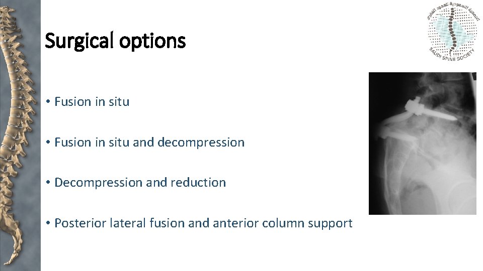 Surgical options • Fusion in situ and decompression • Decompression and reduction • Posterior
