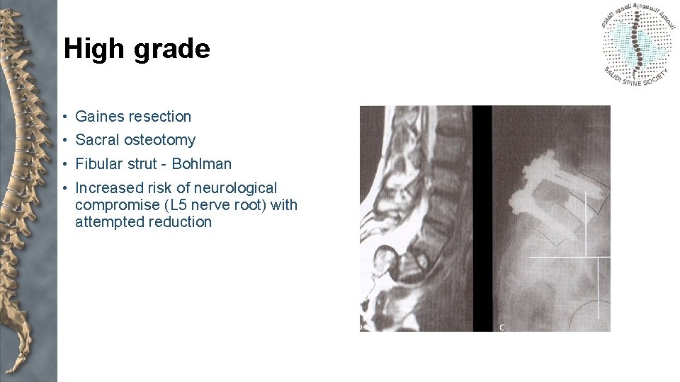 High grade • Gaines resection • Sacral osteotomy • Fibular strut - Bohlman •