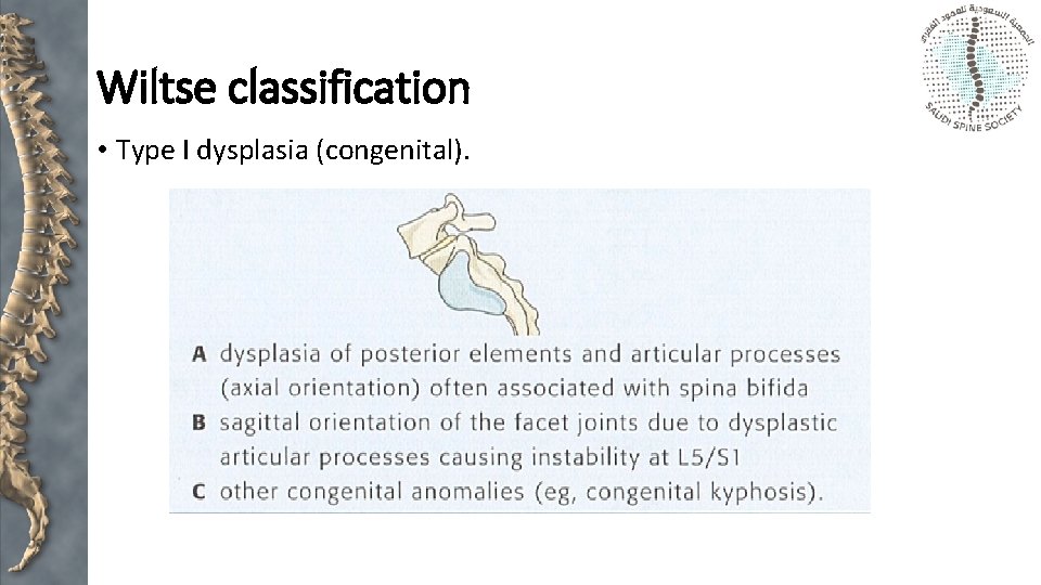 Wiltse classification • Type I dysplasia (congenital). 