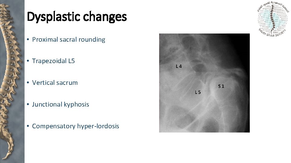 Dysplastic changes • Proximal sacral rounding • Trapezoidal L 5 • Vertical sacrum •