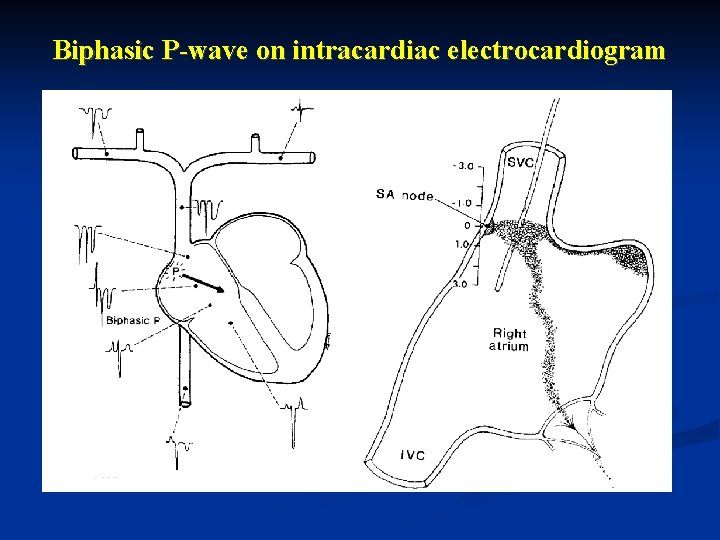 Biphasic P-wave on intracardiac electrocardiogram 