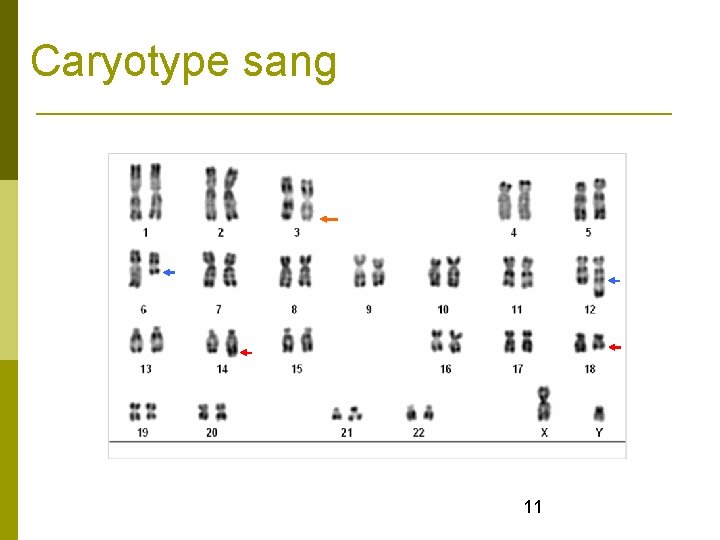 Caryotype sang 11 