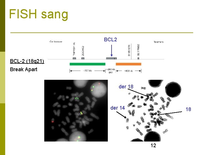 FISH sang BCL 2 BCL-2 (18 q 21) Break Apart der 18 der 14