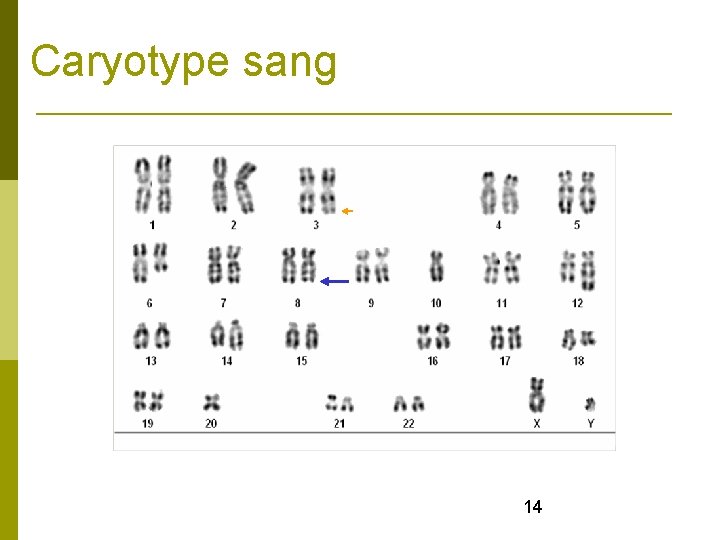 Caryotype sang 14 