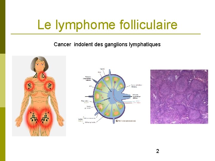 Le lymphome folliculaire Cancer indolent des ganglions lymphatiques 2 