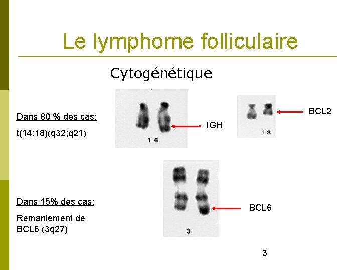 Le lymphome folliculaire Cytogénétique Dans 80 % des cas: t(14; 18)(q 32; q 21)