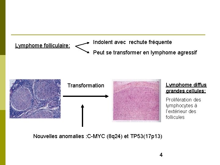 Lymphome folliculaire: Indolent avec rechute fréquente Peut se transformer en lymphome agressif Folliculaire Lymphome
