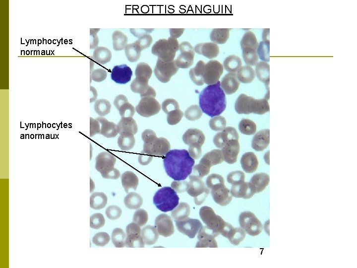 FROTTIS SANGUIN Lymphocytes normaux Lymphocytes anormaux 7 