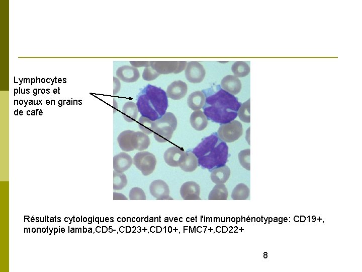 Lymphocytes plus gros et noyaux en grains de café Résultats cytologiques concordant avec cet