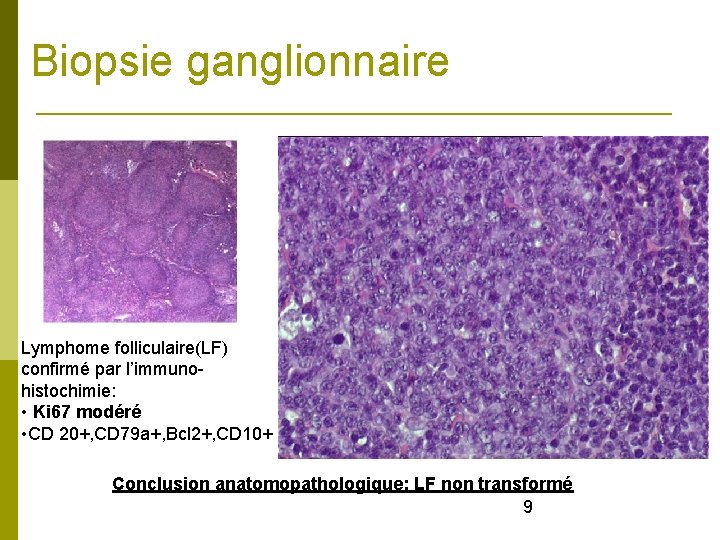 Biopsie ganglionnaire Lymphome folliculaire(LF) confirmé par l’immunohistochimie: • Ki 67 modéré • CD 20+,